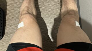 PRP療法を受けた両ひざ